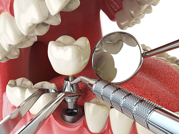 Best Emergency Wisdom Tooth Extraction in Price, UT